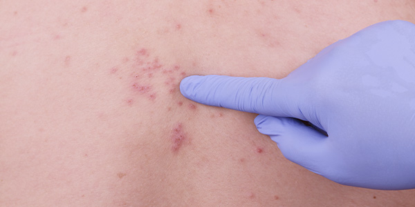 médico apontando para lesões na pele causadas pelo vírus da herpes zoster