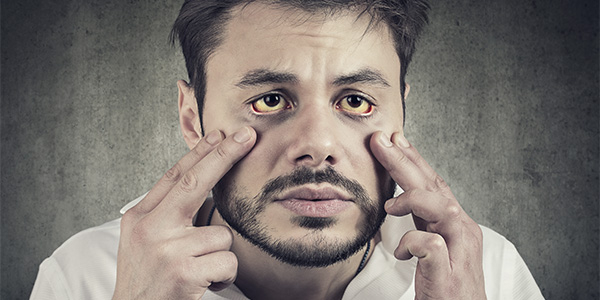 homem com olhos amarelados, um dos sintomas da hepatite B